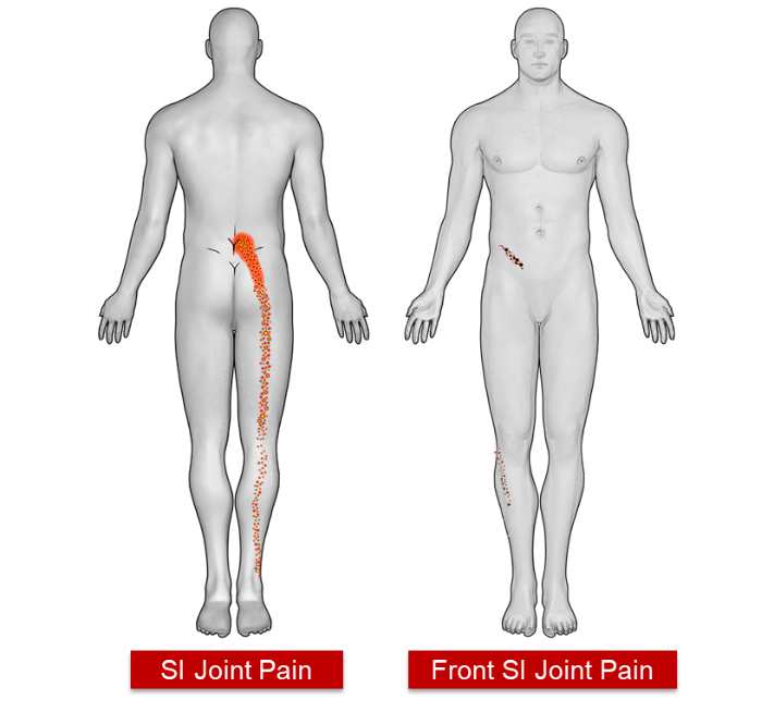 Sacroiliac Joint Dysfunction